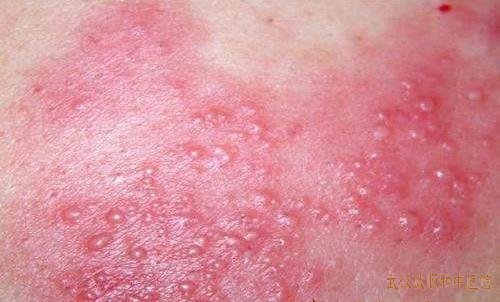 急性湿疹皮肤红肿起水泡丘疹有哪些诱因？中医中药怎么辨证用药有效治疗湿疹？
