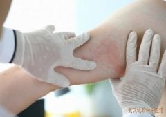 慢性湿疹腿上起片状疙瘩手挠有抓痕中医怎么辨证用什么中药方治疗?