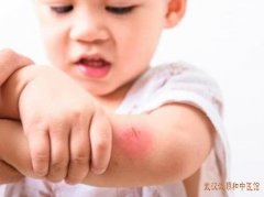 小儿夏季容易起红疹反复不愈是什么原因中医治疗有效果吗?