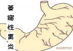 武汉街道口有位胃病名中医：中西医结合治疗慢性萎缩性胃炎效果怎么样