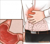 脾胃气机不畅脘腹胀满便秘腹泻交替吃什么中药方子治疗效果好？