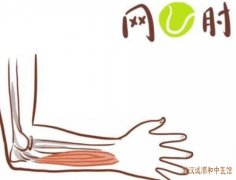 网球肘肘关节外侧酸痛、活动痛、手不能用力持物吃什么中药治疗？