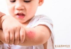 小孩子皮肤过敏怎么改善?常见小儿皮肤过敏症状有哪些?