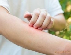 皮肤过敏需要先从缓解瘙痒开始，中医一般如何辨证分型治疗?