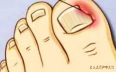 武汉皮肤科专家门诊老中医：甲沟炎右脚趾头红肿疼痛怎么治疗好？