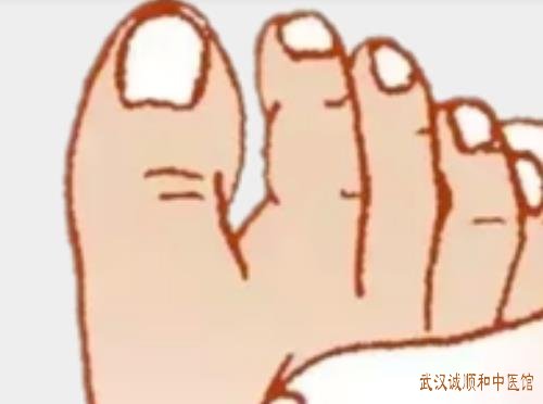 武汉市武昌区附近皮肤科老中医：鞋子太紧挤脚痛引起甲沟炎怎么治？