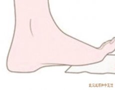 脚指甲穿鞋子太紧，长期挤脚拇指红肿疼痛导致甲沟炎发作怎么治？