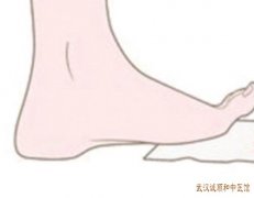 武汉皮肤科有名的老中医：角化型足癣的症状表现治疗方法以及预防措施