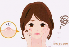 武汉有个厉害的皮肤科专家：痤疮脸上长粉刺很痒用什么中药治？