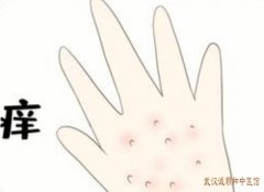 武汉街道口有位皮肤病专家：荨麻疹全身疼痛又痒不停地挠怎么治疗？