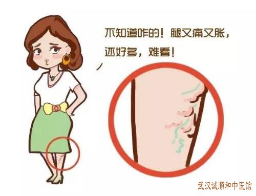 武汉街道口中医内科好的老中医：下肢静脉曲张形如蚯蚓伴有疼痛怎么治疗？