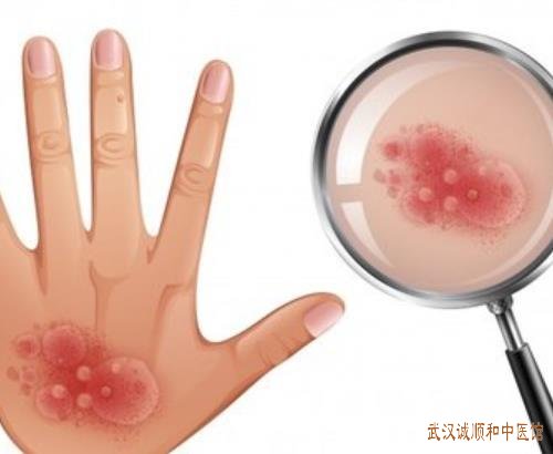 武汉中南路有个看皮肤病厉害的中医：系统性红斑狼疮中医药治疗可以减轻副作用吗?