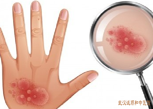 手掌湿疹皮损溃破严重痒痛中医怎么治疗见效快？