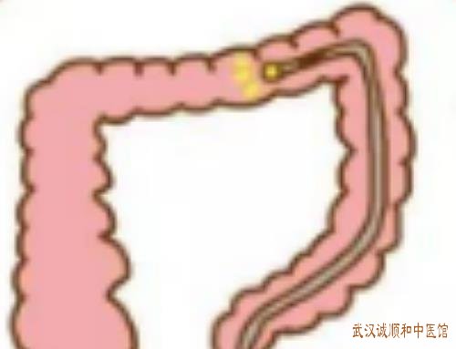 出现腹痛腹泻、脓血便等症状慢性结肠炎太折磨人了选择中医治疗带来的效果好吗？