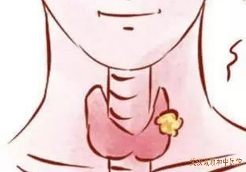 武汉腾龙大道厉害中医肿瘤门诊：中青年女性颈前肿块质地柔韧伴胸胁胀闷乏力怎么调？