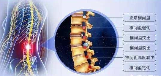 腰椎间盘突出、退化、脱出对比图片