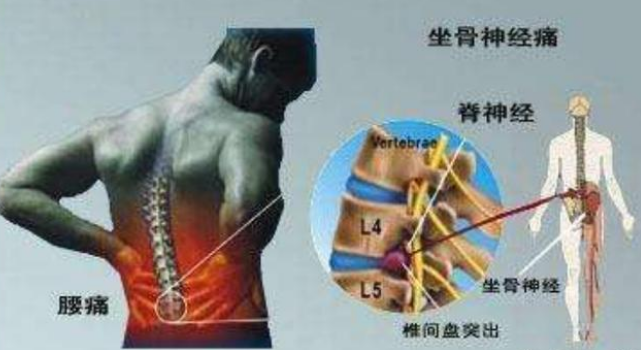腰闪了，腿麻酸疼不能久坐，坐骨神经痛怎么办？
