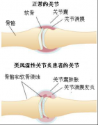 关节畸形受累晨僵活动受限得了类风湿关节炎咋办？