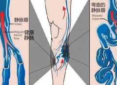 青筋隆起、肢体不适，静脉曲张怎么治疗？中医讲究辨证施治！