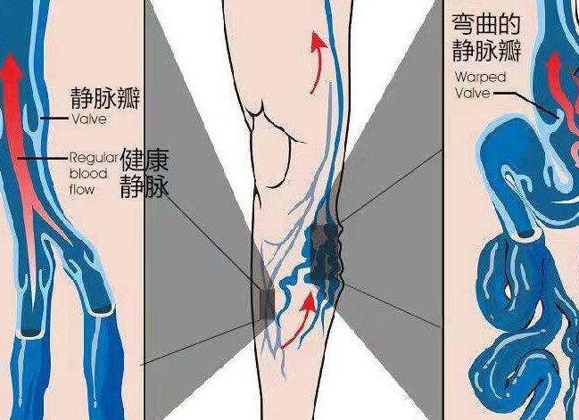 静脉曲张的病情分型