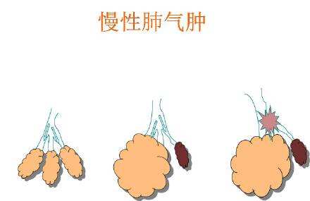 慢性肺气肿