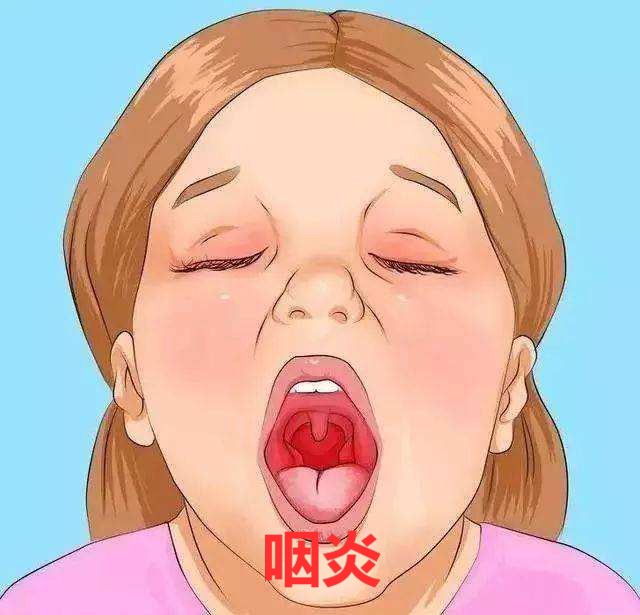 咽炎