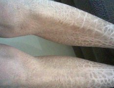 小腿出现脱皮等症状特征，注意是这3种鱼鳞病！