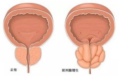 了解前列腺增生7个症状特征，早发现早治疗早康复