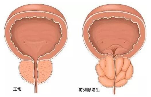 了解前列腺增生7个症状特征，早发现早治疗早康复