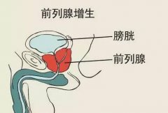 前列腺增生的5种生活中的致病因素，男性朋友大多有过