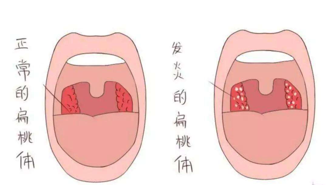 咽峡炎与扁桃体炎区别图片