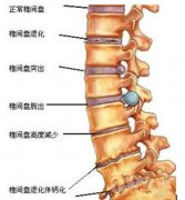 腰椎间盘突出的临床症状有哪些？