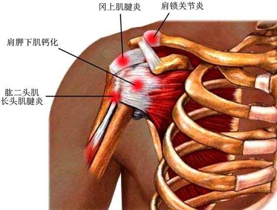 肩膀酸痛是怎么回事图片