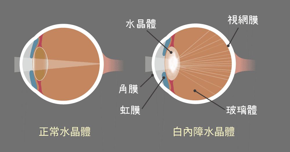 二、中医对白内障的辨证论治