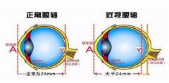 青少年近视影响视力怎么办？中医治疗效果怎么样？如何有效预防呢？