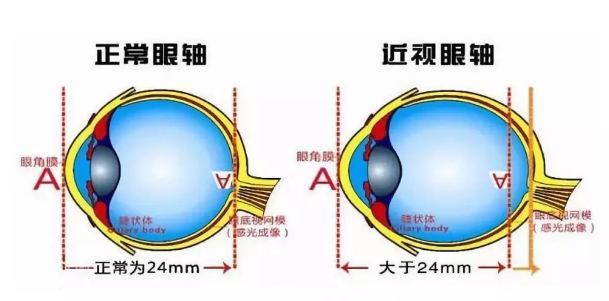 近视眼