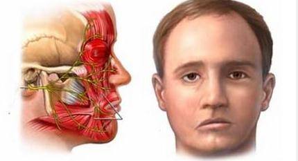 面瘫的症状初期图片图片