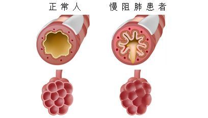 中医可以治疗中度慢阻肺吗？