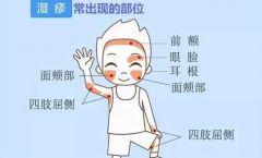 范平：慢性湿疹的症状图片是什么样子的？中医如何调理？