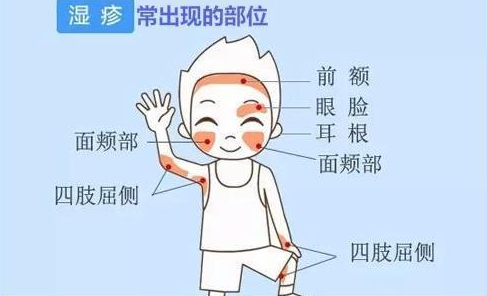 慢性湿疹的症状图片是什么样子的