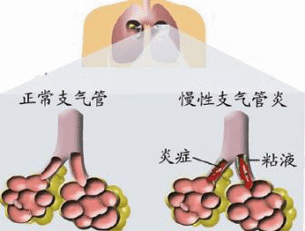 十多年的慢性支气管炎为什么老治不好？