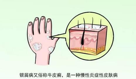 得了银屑病老治不好该怎么办？
