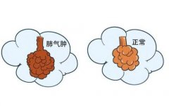 向贤德：肺气肿嗓子总是有痰能治好吗？