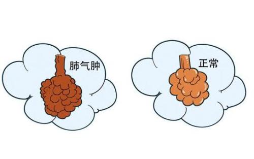肺气肿嗓子总是有痰能治好吗？