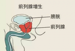 前列腺增生夜尿七八次怎么治疗比较好？