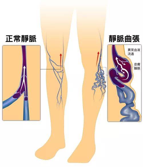 大腿静脉曲张浮肿疼痛难忍