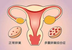 姜瑞雪教授：多囊卵巢综合征月经不调中医怎么调理？