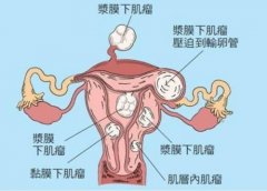 月经发生变化、月经周期改变、经量和质地改变子宫肌瘤中医辩证治疗