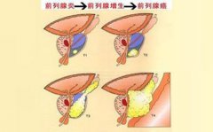 前列腺增生夜尿多怎么调理？徐长化教授妙方清热利湿活血化瘀