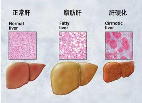 肝硬化腹水吃什么中药消腹水比较好？